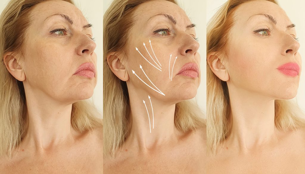 Dermal Filler Perfection