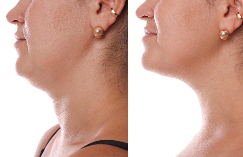 Fat-Dissolving Injections