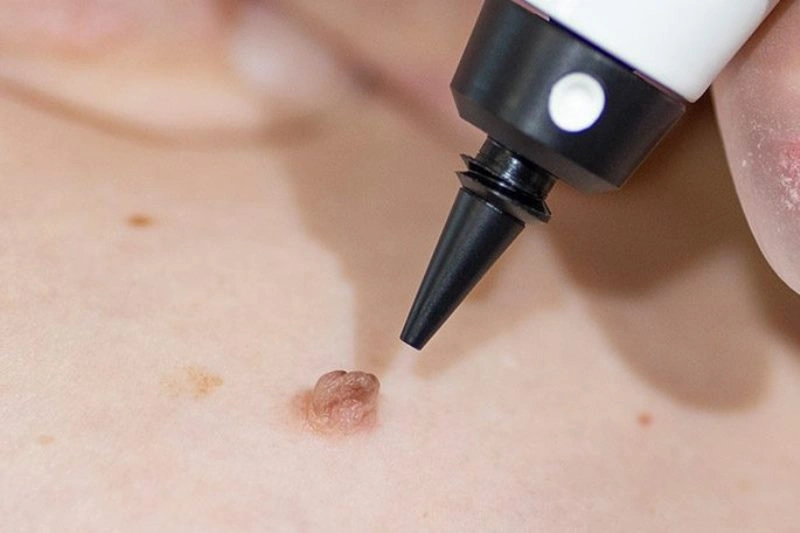 Dermal Fillers